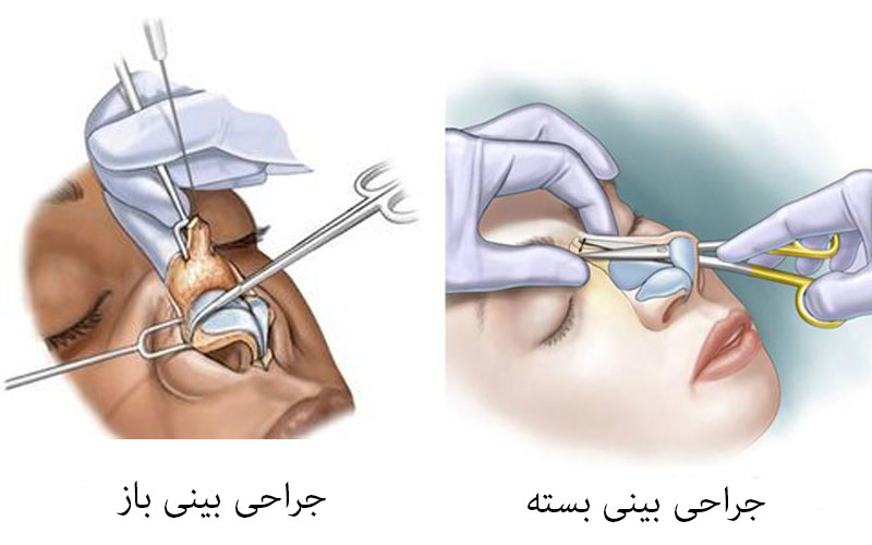 تفاوت رینوپلاستی باز و جراحی بینی بسته
