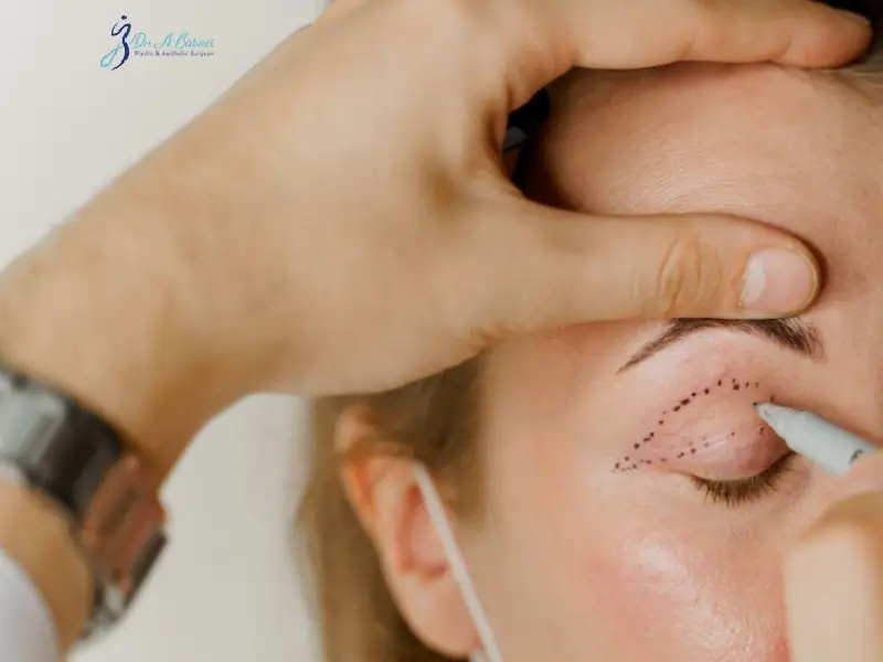 بهترین جراح بلفاروپلاستی در تهران