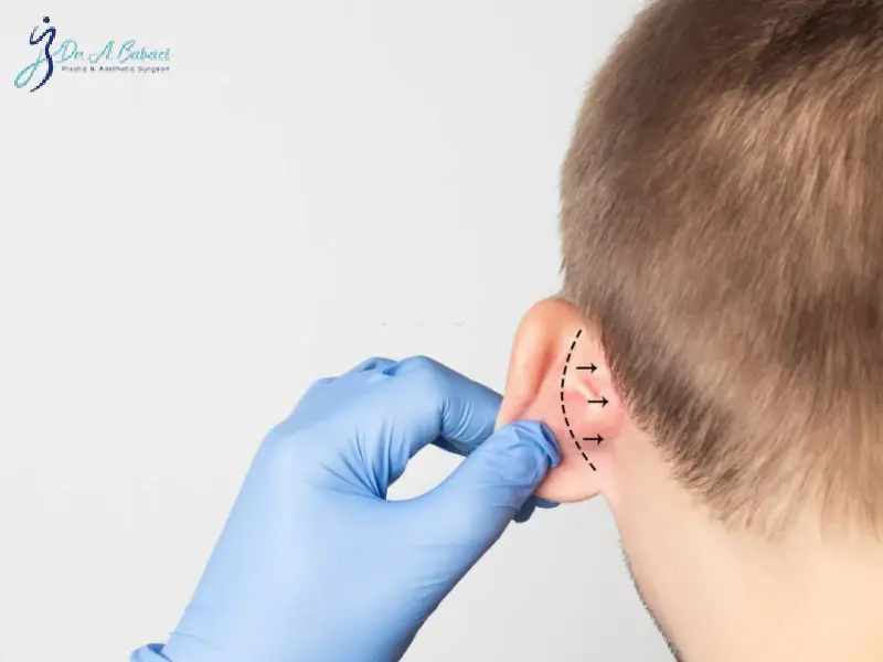 مراقبت های بعد از اتوپلاستی